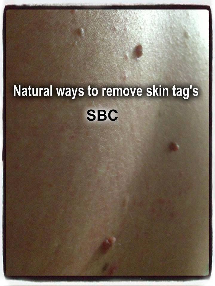 3 Herbal Treatments to remove skin tags that actually work ...